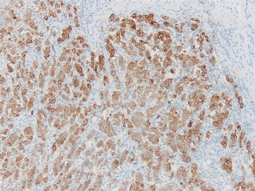 3580B | Control Slides:Immunopathology; Melan-A (MART-1)